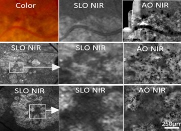 High resolution imaging for ophtalmology: adaptive optics and beyond